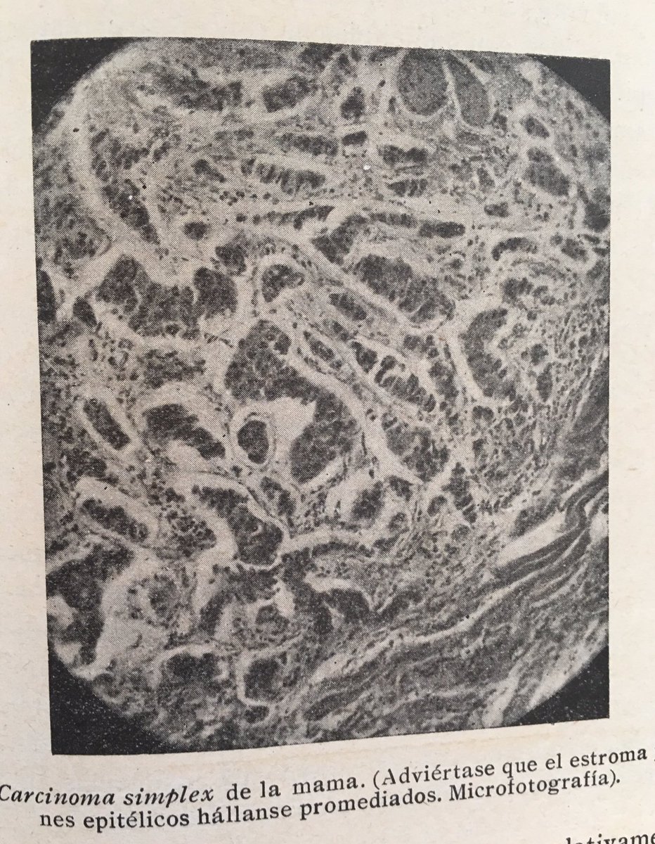 pathosaranda's tweet photo. Los patólogos saben lo que es cáncer hace mucho tiempo. A. Patológica de Cajal, 1918. #pathology #Cancer #patólogo https://t.co/qWVkMzRcAB