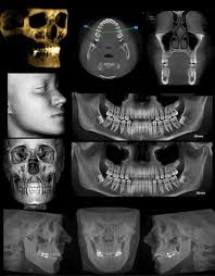 La imagen #Retex7, un estudio #CBCT es esencial para un correcto abordaje y tratamiento.