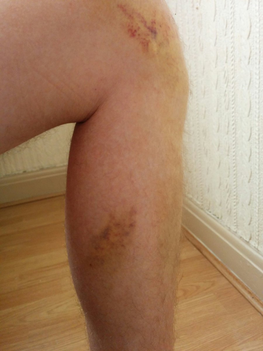 Public service announcement. Always wear a helmet when cycling. Head injuries are not to be laughed at.