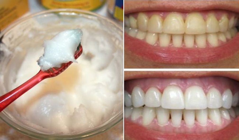 Home Remedy for Super Fast Teeth Whitening with Coconut Oil and Baking Soda  goo.gl/eKrq8M