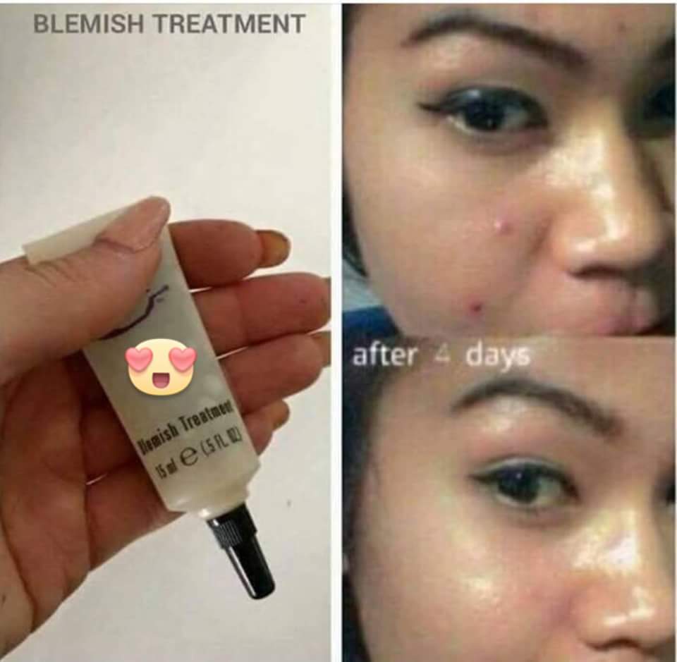 Amazing blemish treatment!!  Get yours asap xx