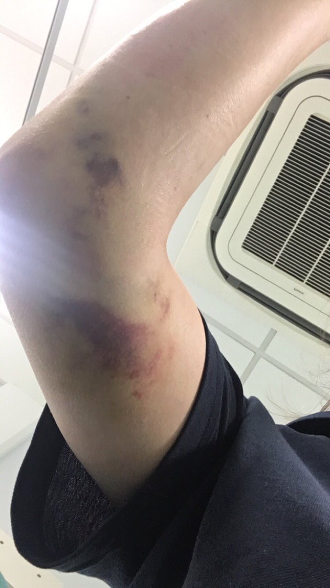 TillyrieStables's tweet image. Signed off for 6 weeks not ideal #dislocated #elbow 
Cast is off and I have a slab cast now! #physio #recovery 🙁