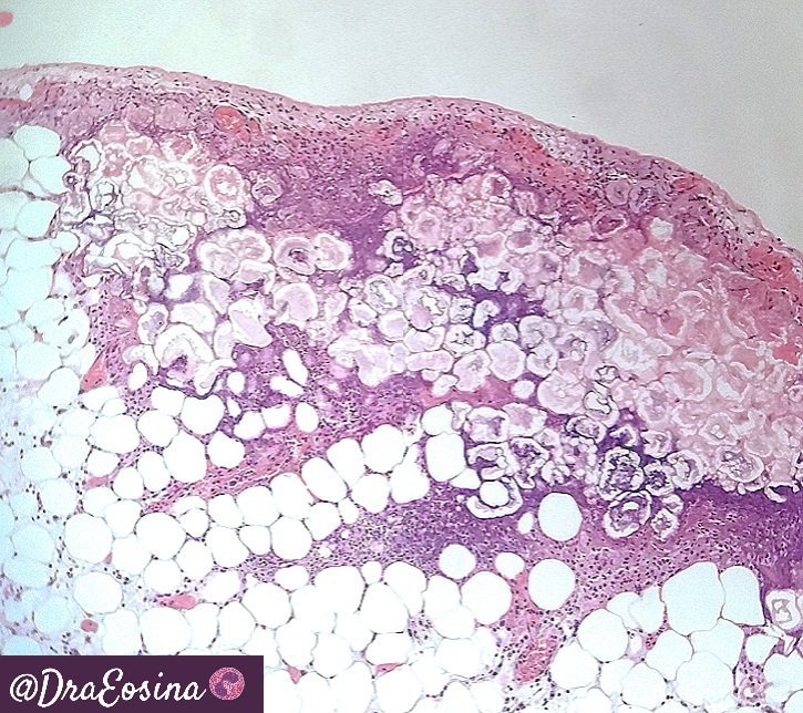 Laura G. Pastrián MD on X: "@PancPathologist Saponification trough the  microscope. I saw this just today. Happened after surgery for a TNE.  https://t.co/v65hCTvOAh" / X