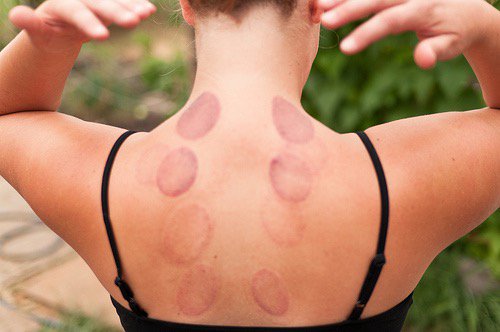 RealCall2Health's tweet photo. 150 points- Did cupping therapy. #RealCall2Health #olympics #BOP #PCUSA https://t.co/zvQwcTFvnS