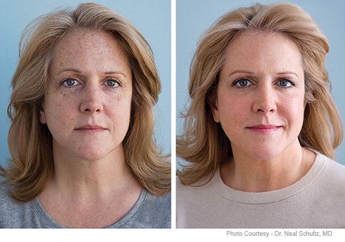modsculpt's tweet photo. #Sculptra
Reduces wrinkles and facial folds. 
https://t.co/m5VetZgfQt  #MODSculpt #Houston #SugarLand https://t.co/p8BMvhCbOx