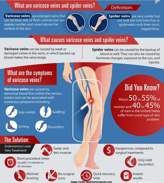 saddison94's tweet image. Varicose #Veins Prevention With This Amazing Juice bit.ly/2avZNCW #healthcare @ConsumerHDigest