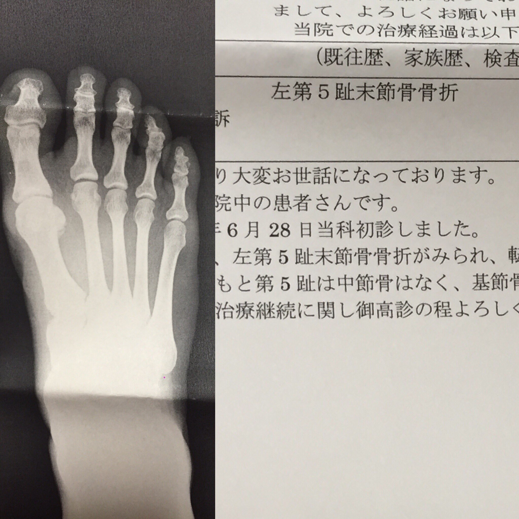 いしいめぐみ そろそろ完治かな 明日朝一医者行ってレントゲン撮って診てもらおうかな 骨折 骨折治ったかな 右足小指 足 の小指 T Co Uhb97jty8d Twitter