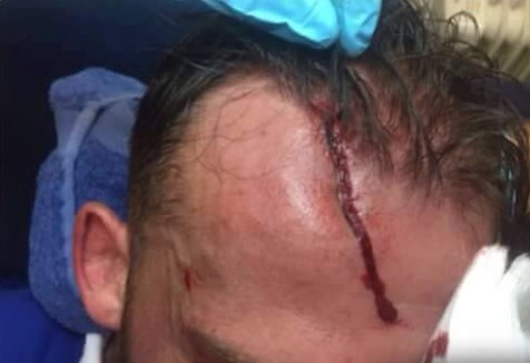 Owlsonline's tweet photo. Err… This is the result of the clashed heads at the weekend for @stevenfletch10 
#swfc #OUCH https://t.co/rFrejw8iRM