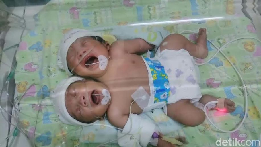 detikcom's tweet image. Bayi dengan Kondisi Kepala Dua Lahir di Gresik detik.id/6hV4Bu