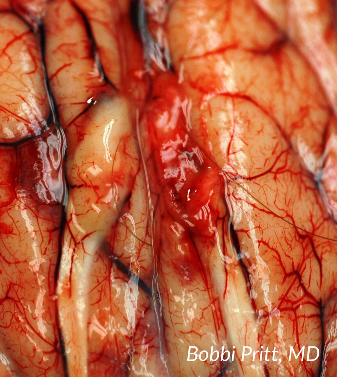 TheUSCAP's tweet image. Naegleria fowleri amoeba in brain. Small trophozoites, pale nucleus= easy to mistake for host cells #Pathology