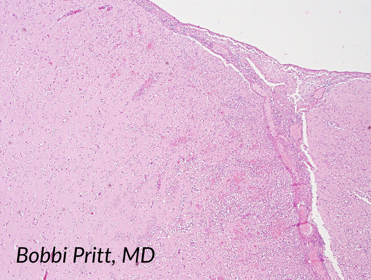 TheUSCAP's tweet image. Naegleria fowleri amoeba in brain. Small trophozoites, pale nucleus= easy to mistake for host cells #Pathology