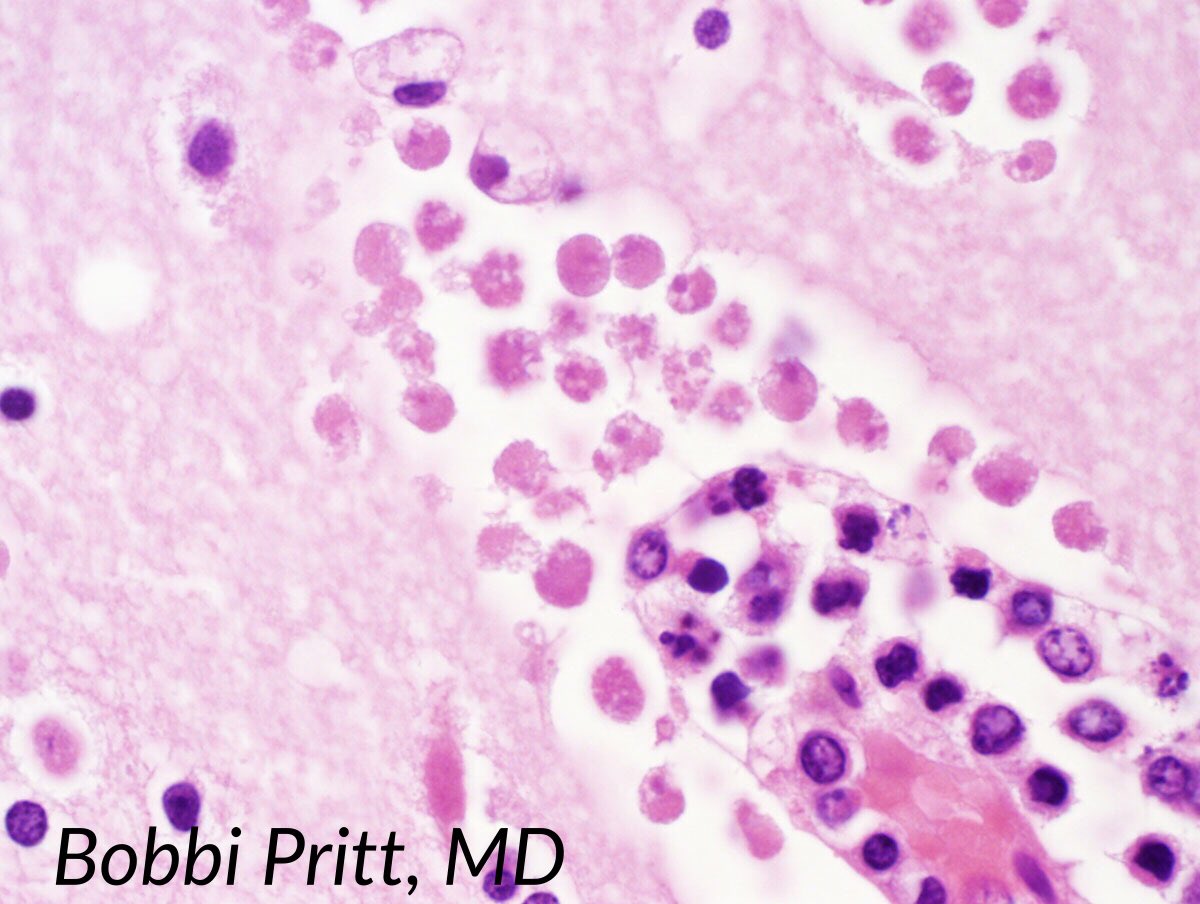 TheUSCAP's tweet image. Naegleria fowleri amoeba in brain. Small trophozoites, pale nucleus= easy to mistake for host cells #Pathology