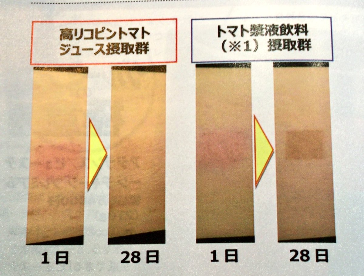 カオイ Sur Twitter 日焼けした後トマトジュース 高リコピン を1ヶ月飲み続けたらほぼ治った すごすぎる 高リコピンジュース リコピンが殆ど含まないトマトジュース だからゆいちゃんこんなに白いんだ カオイ Sur Twitter 日焼けした後トマトジュース 高リコピン を1ヶ月飲み続けたらほぼ治った すごすぎる 高リコピンジュース リコピンが殆ど含まないトマトジュース だからゆいちゃんこんなに白いんだ