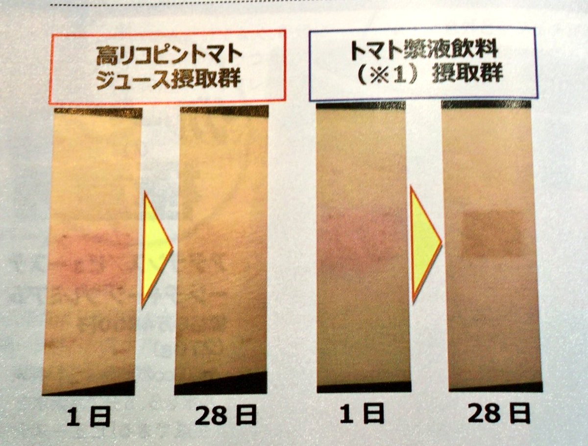 カオイ Sur Twitter 日焼けした後トマトジュース 高リコピン を1ヶ月飲み続けたらほぼ治った すごすぎる 高リコピンジュース リコピンが殆ど含まないトマトジュース だからゆいちゃんこんなに白いんだ