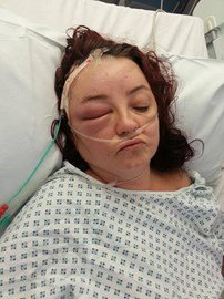 welshtartnproud's tweet photo. @AVMSurgeon Hi Mr Walsh.I'm the one who gave you a fake brain and said i'd have my head shaved well i'm doing it !!! https://t.co/LlMfqOmXMK