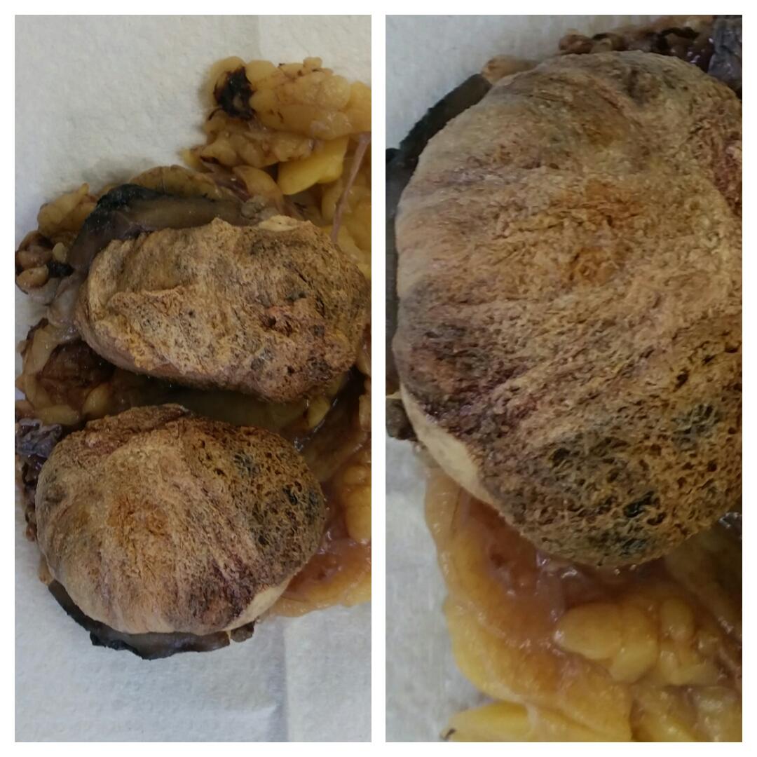fahdrefai's tweet photo. Papillary Renal Cell Carcinoma (PRCC). https://t.co/LM48CJe52b