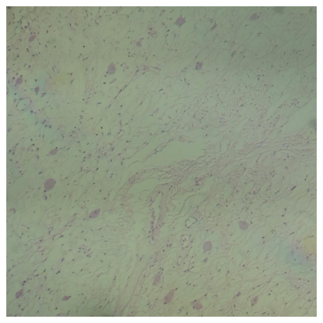 fahdrefai's tweet photo. 27 year old patinet with 2.5 cm Pleural tumor. https://t.co/HHIWhriYB2