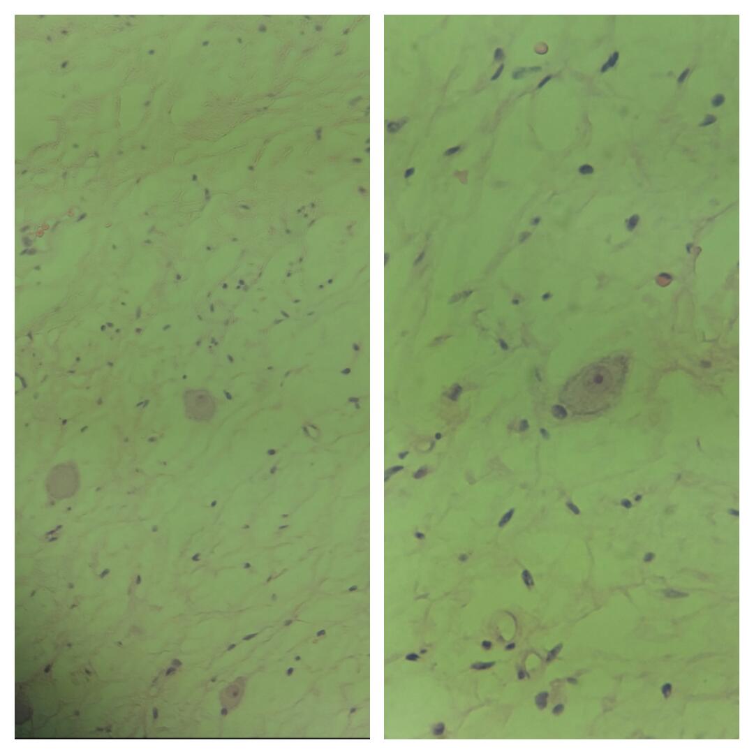 fahdrefai's tweet photo. Ganglioneuroma.
Mature ganglion cells with intervening stroma https://t.co/XB56OpsYji