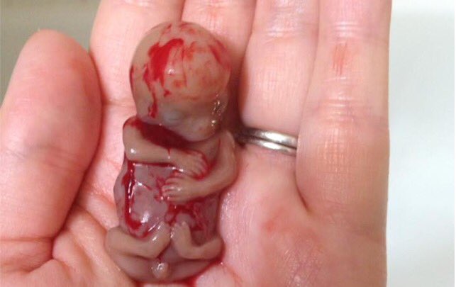 MullinAnneMarie's tweet photo. Thank you to the Burns's for sharing the photo of 11 wk old son Ezekiel who was miscarried. https://t.co/s4qJgGAwos https://t.co/qPXpa5bgkM