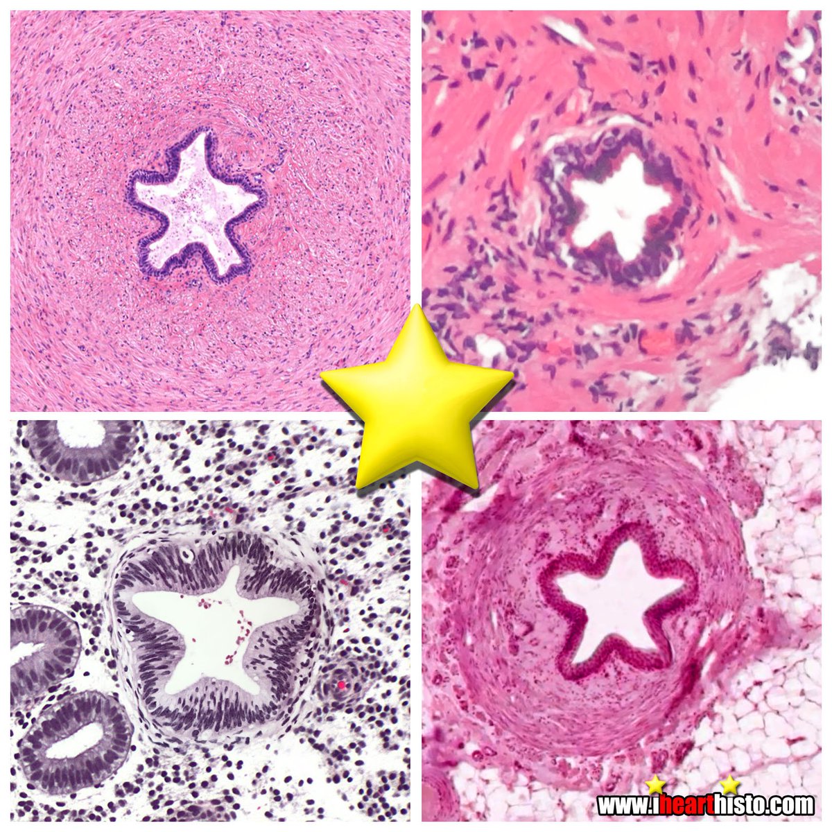 IHeartHisto's tweet image. 🌟 Stars in (between) your thighs 🌟
Stellate holes in reproductive organs* 
#histology #pathologists
* and 1 urinary