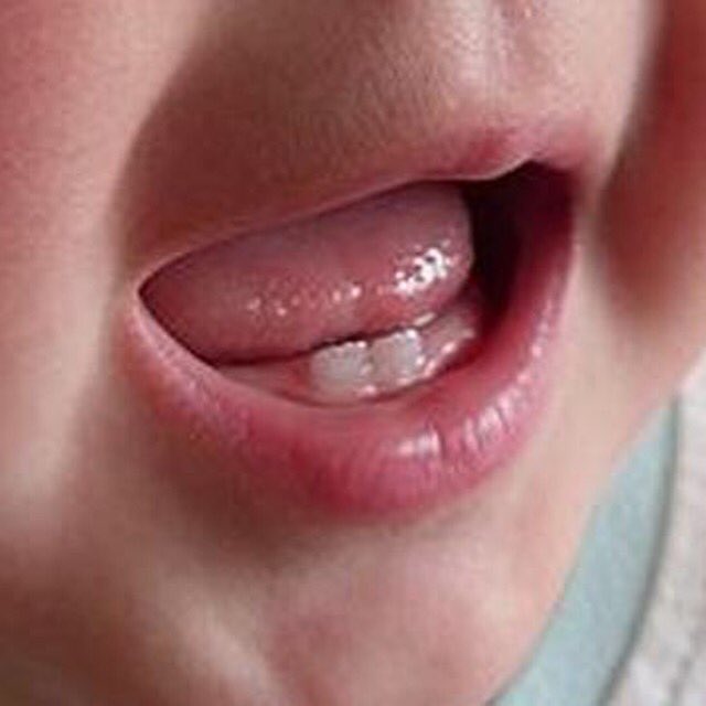 MCDsmilesDDS's tweet photo. Did you know that 1 out of 2,000 babies are born with a tooth? #funfact #natalteeth #ADA #yummymummy #mcdsmiles https://t.co/SoECtLx7Q9