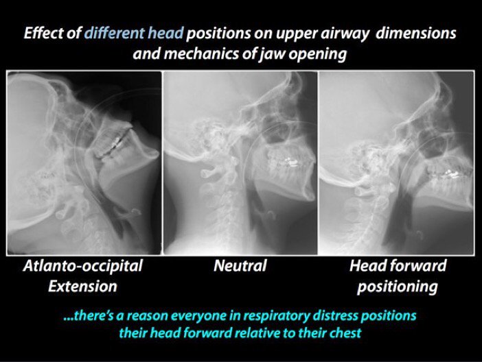 EM_RESUS's tweet photo. Love this slide from @airwaycam:

1. Don't crank the neck back
2. Elevate the head!

#FOAMed #FOAMcc https://t.co/xN1peeqcFk
