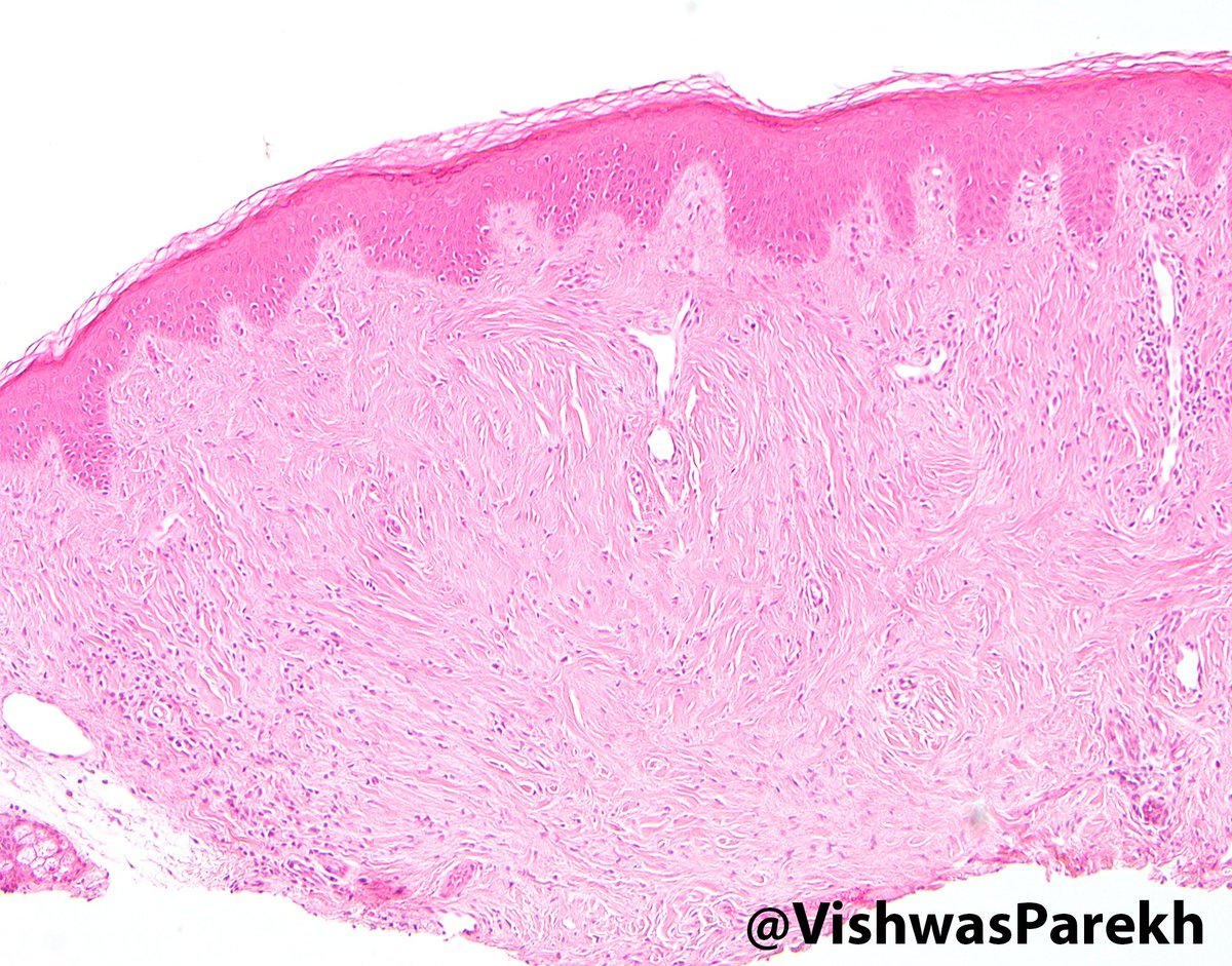 Fibrous Papule: Skin-colored, on nose/central face. Stellate fibroblasts, dense collagen, ectatic vessels. #Dermpath