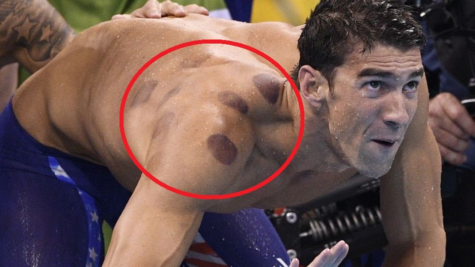 ChicharroJL's tweet photo. Los fisioterapeutas advierten de que el 'cupping' no tiene evidencia científica
https://t.co/Jtyl0STSf5 https://t.co/W1OMEMTfdz