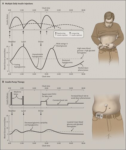Múltiples aplicaciones de #insulina vs.  Terapia con Bomba (o Microinfusor) de #insulina.