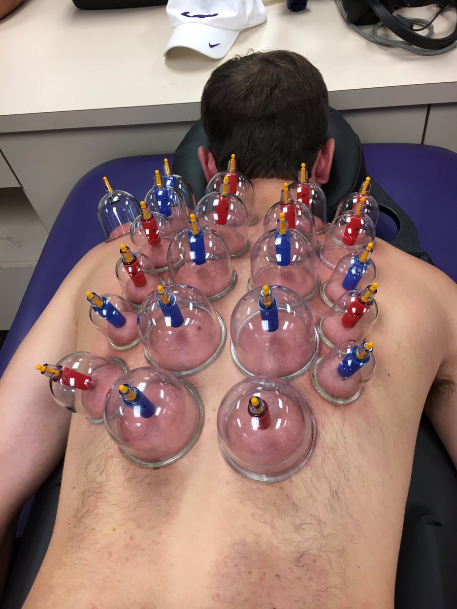 LSUAthTraining's tweet photo. Try to get on our level @MichaelPhelps #cupping #fascialrelease https://t.co/UQGYLTeUIL