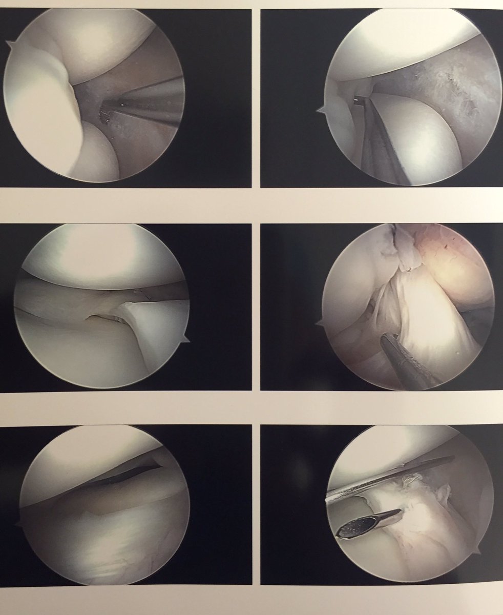 kneedoc74's tweet photo. Massive BH tear MM repaired using #fastfix360 and #meniscalmender #Smith_nephewPLC https://t.co/gsYDukhdxG