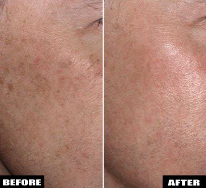 NeilSadickMD's tweet photo. Fraxel uses non-ablative lasers to reduce #sunspots, so you have little to no downtime. - https://t.co/ZNB9pIcXPG https://t.co/5gQBEgz3Pj