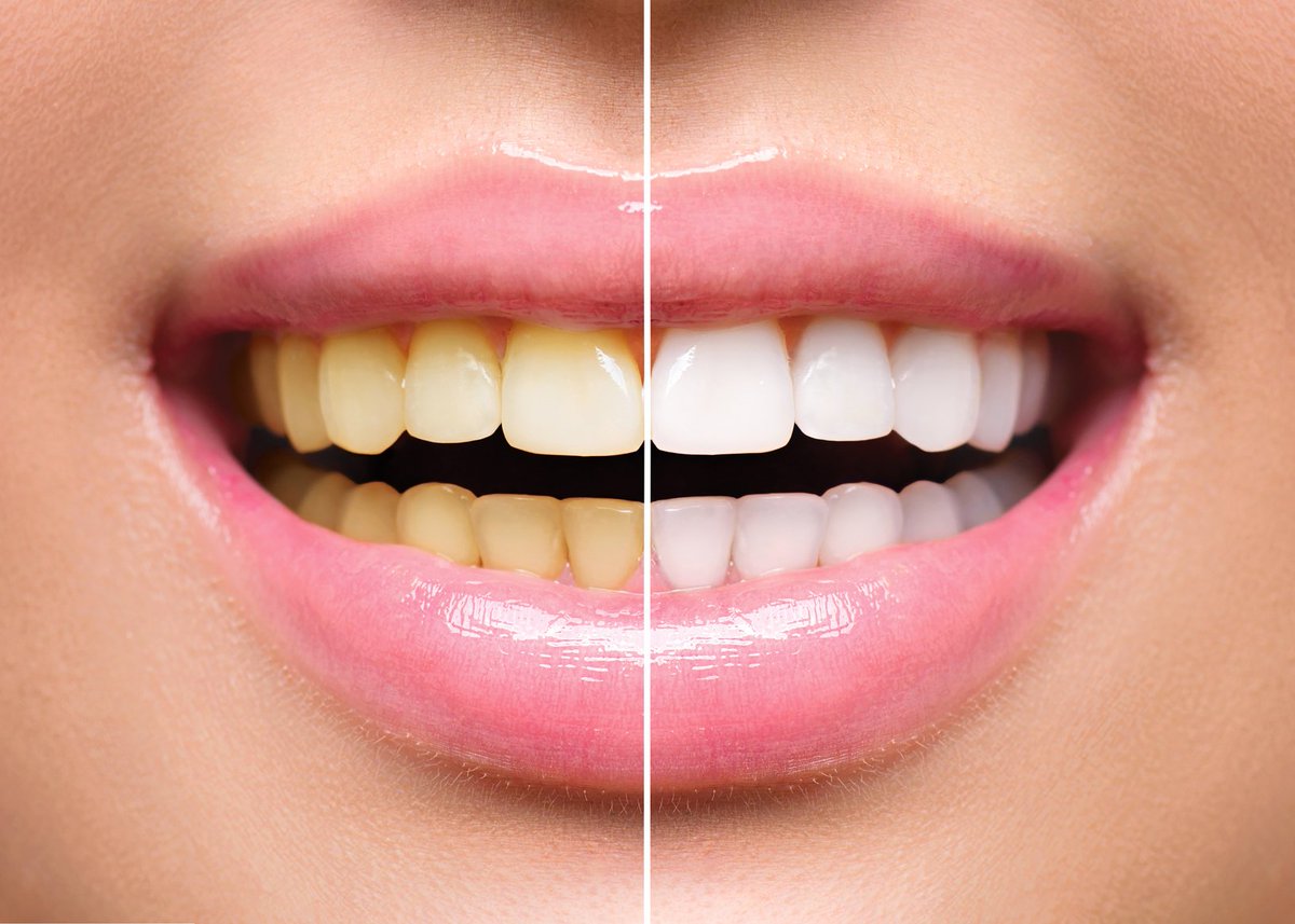 Teeth whitening is an effective way of brightening your teeth, discover how we can help - shareasmile.co.uk/pdfs/Bleaching…