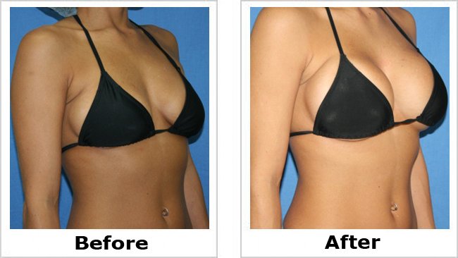 TXclinic's tweet image. Get great results like this at texas-breastimplants.com 
#breastreconstruction #plasticsurgery