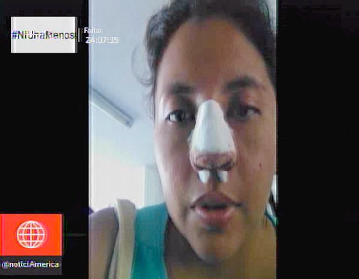 noticiAmerica's tweet photo. #NiUnaMenos: periodista denunció que expareja le rompió el tabique ► https://t.co/CGGy2vgiSn https://t.co/bnUiUbW3EL