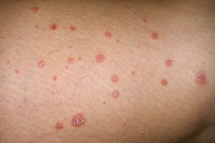 PureBodyButters's tweet photo. #Autoimmune #diseases may be side effect of a strong #immune system
https://t.co/lLKEUcka0b
#psoriasis #eczema https://t.co/iaV8G3XfED