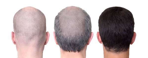 Saç ekimi nedir? bit.ly/2aPp0nr