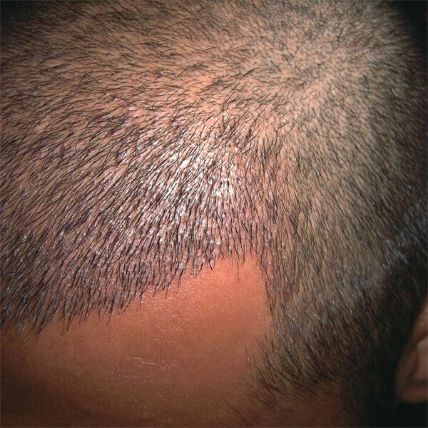 Fue saç ekimi tekniğinin özelliği nedir? bit.ly/2b1kRQN