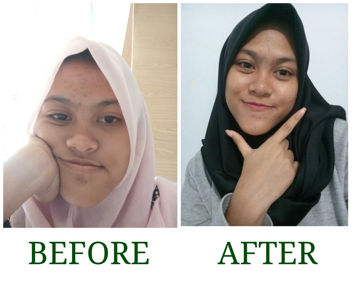 fauziahnadha's tweet photo. Thankyou, @TheBodyShopIndo! Berkat #MyDropsofYouth kulit muka jadi lebih terlihat cerah, lembut and bye acne marks! https://t.co/V9ZZYSi16L