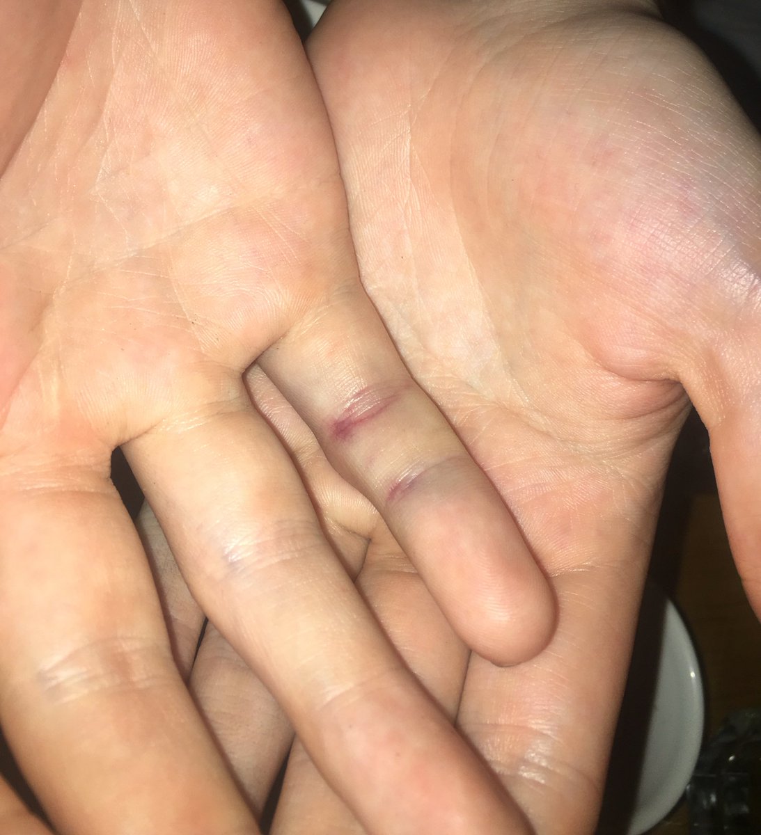 Callux's tweet image. Aftermath of being in goal the other day.. idek if it's broken but it hurts so much to move it.