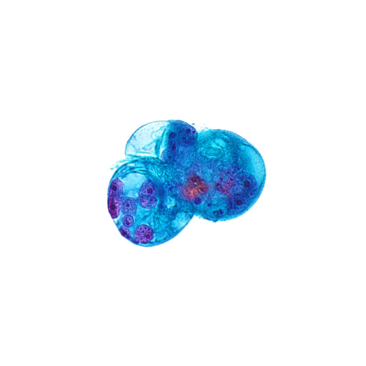 A cluster of multi-nucleated #malignant cells in the same #pleuralfluid #cytology as the last 2 posts. #papanicolaou