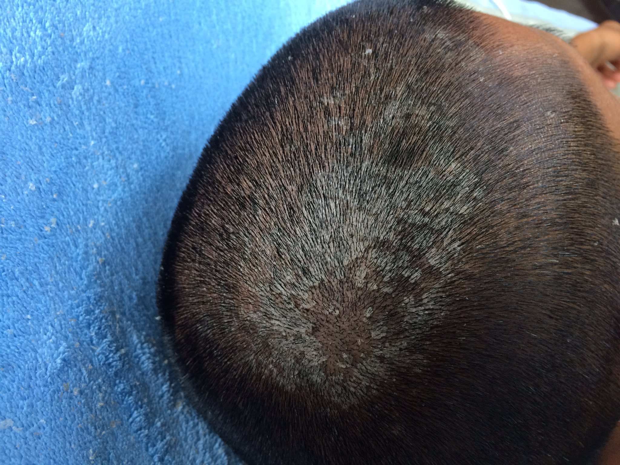 Ggゆうご 合宿で頭皮が日焼けし 皮がめくれてきました うむ シャレにならん T Co Splm6bg4xb Twitter