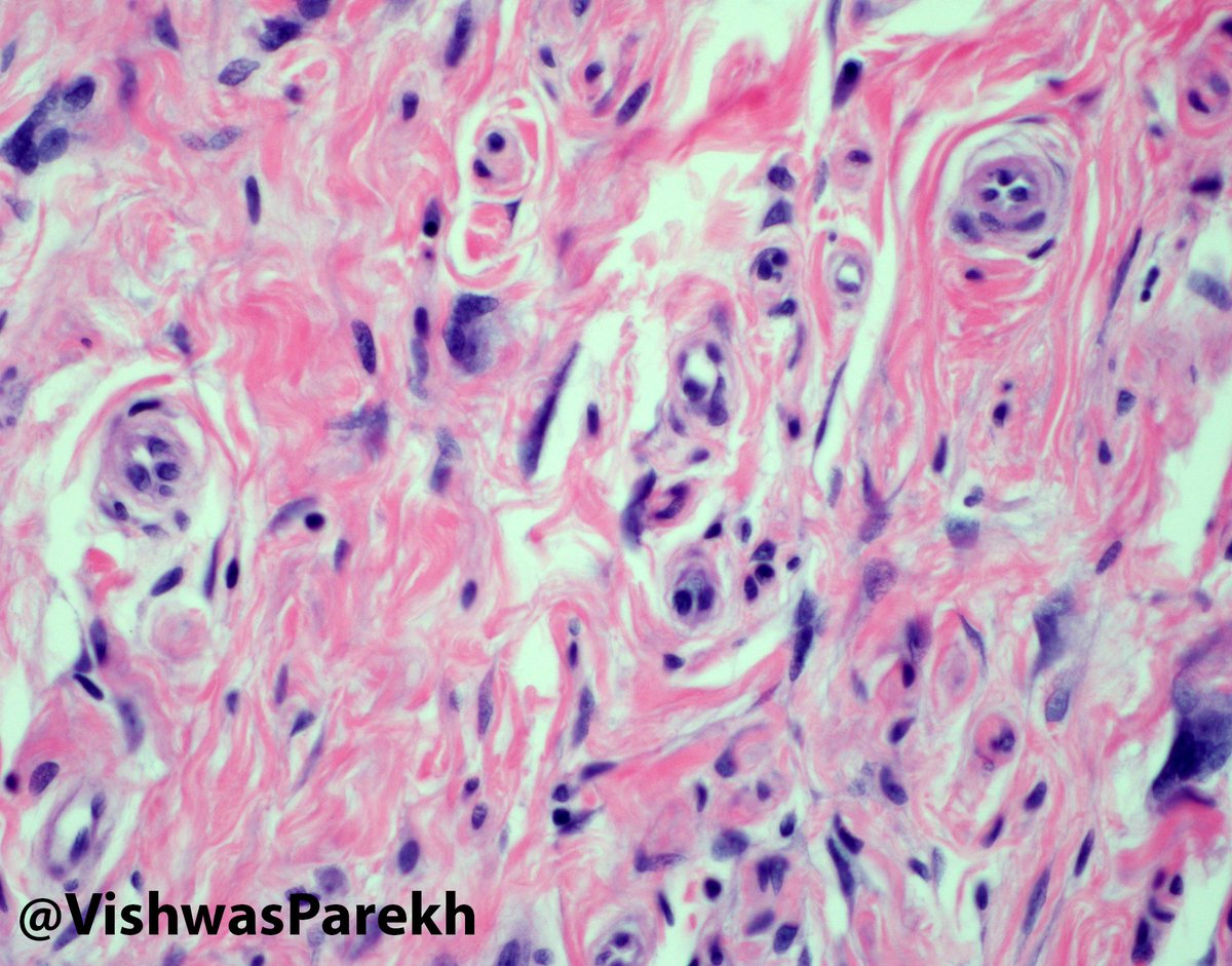 Multinucleate Cell Angiohistiocytoma—angulated multinucleate cells, numerous capillaries, F13a+ #Dermpath #Pathology