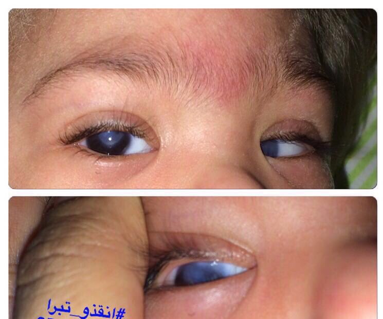 Storwd's tweet photo. طفلة تعاني منذ عام حسب كلام والدها بدوامة التحويلات من مستشفى لأخر رغم حالتها اللي تحتاج تدخل فوري 💔
#انقذو_تبرا https://t.co/KDznoT9Ikz