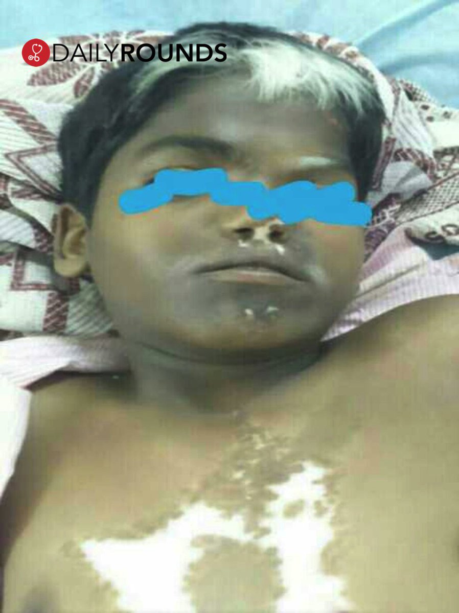 Dailyrounds On Twitter White Forelock Of Hair Heterochromia