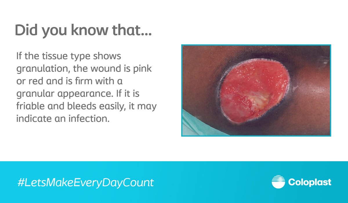Coloplast_WCare's tweet image. During granulation, the wound is pink or red and is firm. If it is friable and bleeds easily, it may be infected.