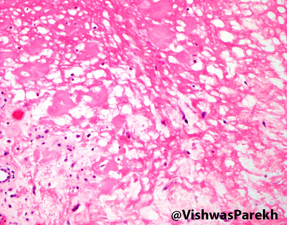 Ischemic Fasciitis—decubital, on bony prominences, zones of fat, fibrinoid necrosis &amp; capillaries. #Dermatopathology