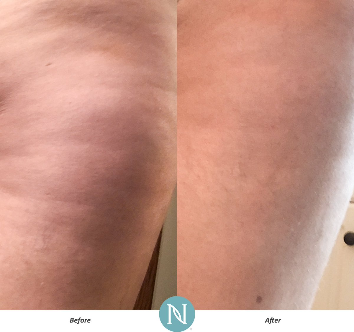 Lib4Health's tweet image. Nerium Body Contour Cream can help you improve the appearance of cellulite! Get yours now:  c.nerium.it/bHV3z
