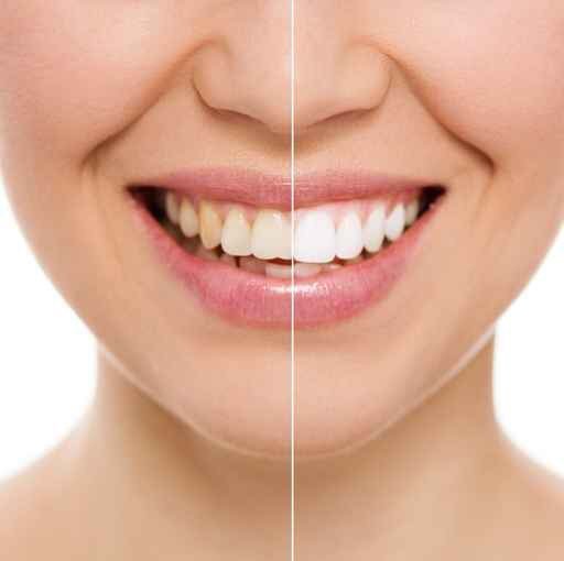 GaskellDental1's tweet image. 10 ways to get white teeth without a professional ow.ly/WBjCU #Dentist #Knutsford #WhiteTeeth