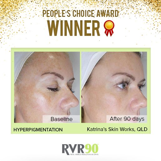 Ultraceuticals's tweet photo. "Melasma is incredibly difficult to treat so this is a really dramatic result.” - Dr Heber, Ultraceuticals Founder https://t.co/eu4R2ZT8a8